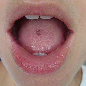 Tongue Retainer Customer Photo